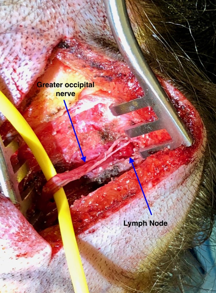 Nerve Release Surgery