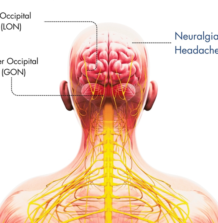 occipital nerve surgery