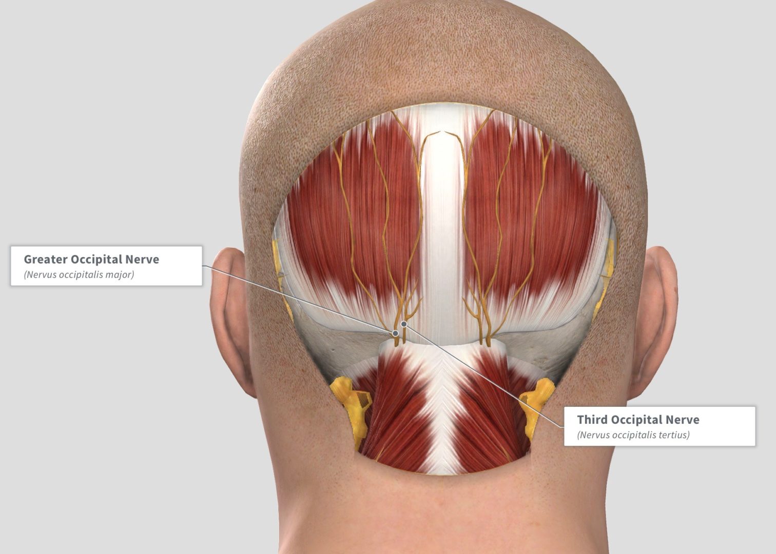 Headache Quiz | Migraine Surgery Specialty Center | Montecito Plastic ...