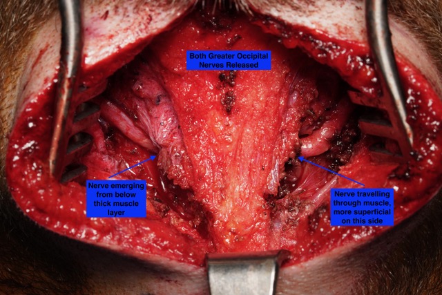 Occipital Nerve Decompression Photos | Migraine Surgery Specialty Center